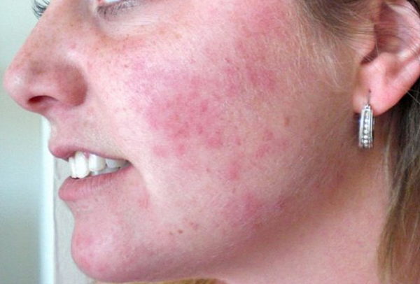 Инфекционная сыпь: характерные черты и отличие от аллергических высыпаний