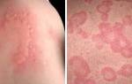 Может ли быть аллергия из-за нервов?